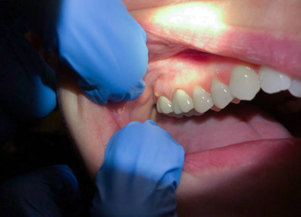 Best Emergency Dentist for Lost Fillings or Crowns in South Boston, VA